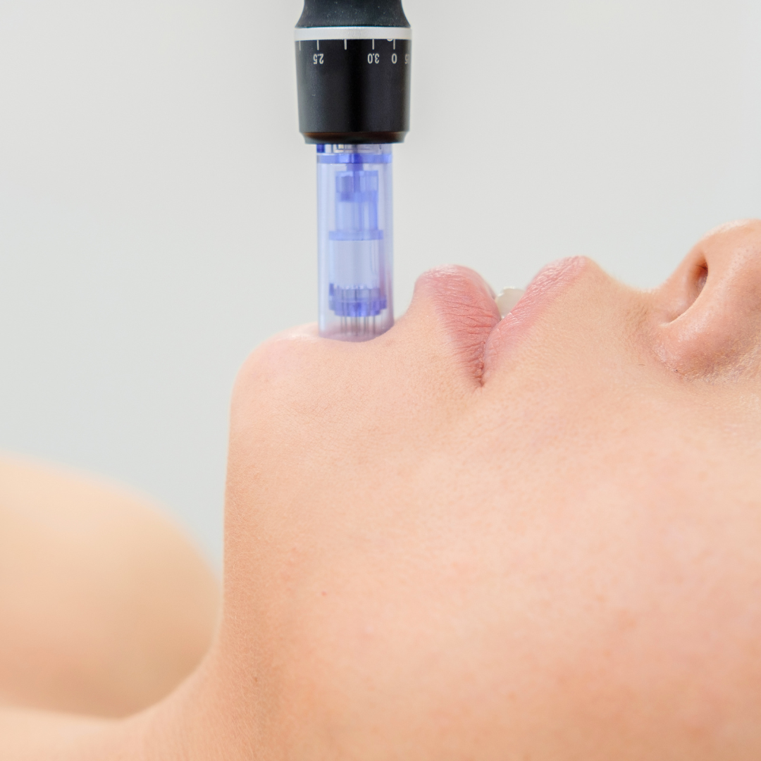 Microneedling